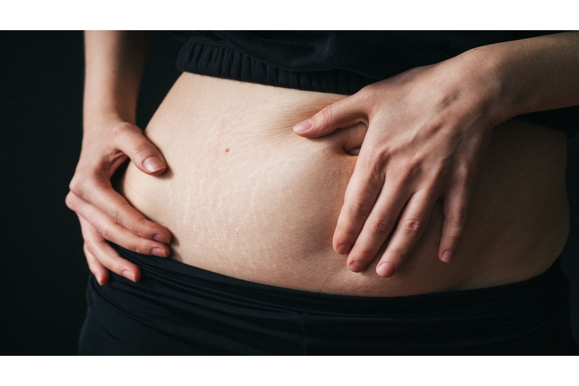 close-up-of-female-showing-stretch-marks-women-b-2023-11-27-05-37-07-utc--1-