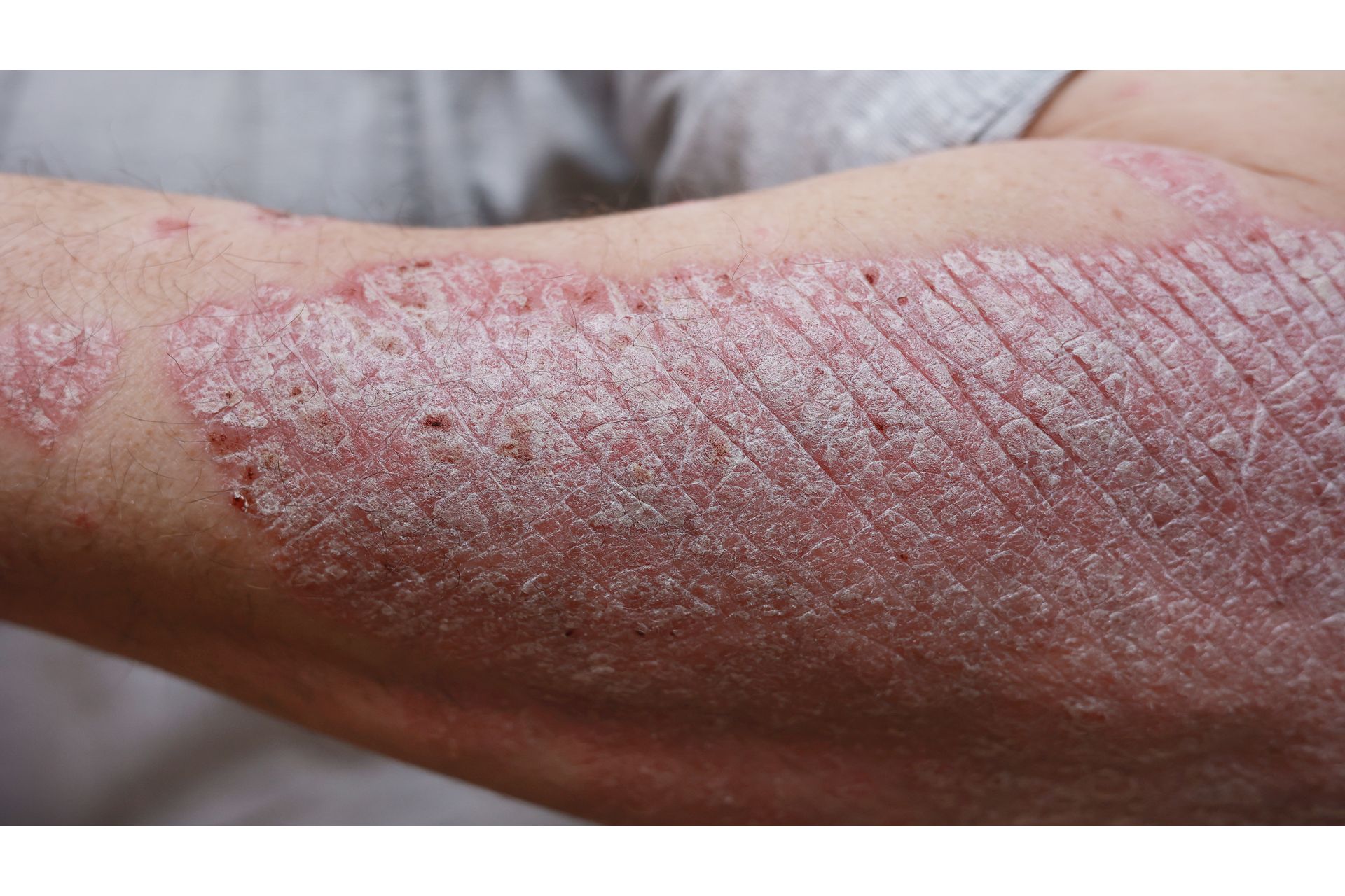Saúde da Pele: Queratose Pilar, Foliculite e Psoríase