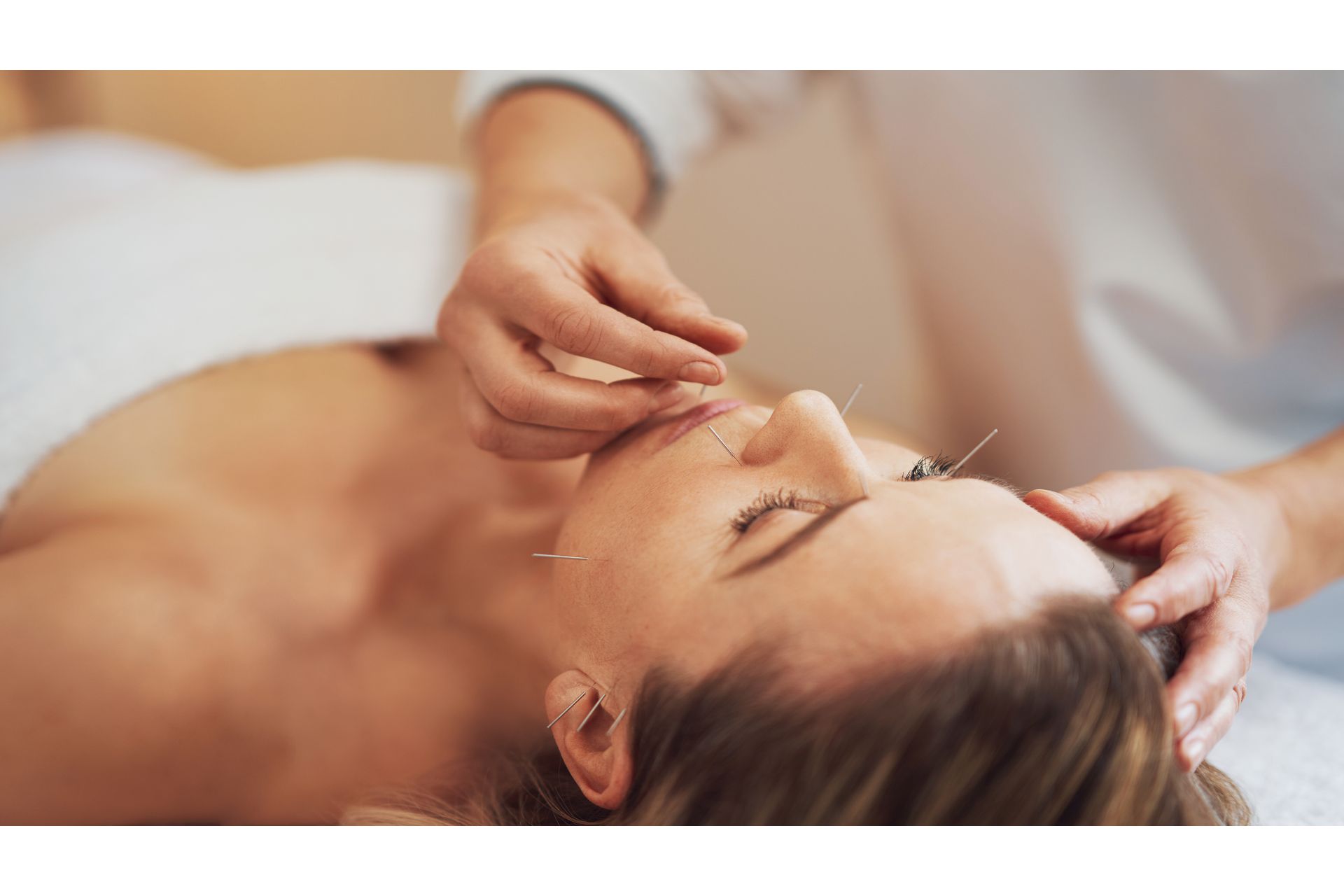 Estética Facial: Aplicações de Acupuntura